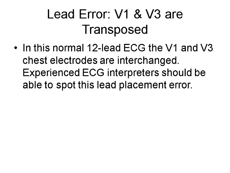Lead Error: V1 & V3 are Transposed  In this normal 12-lead ECG the
